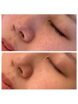 エピス(eps.)/毛穴洗浄before/after