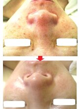 サロンドエステケイワイ(de KY)/フェイシャル☆濃いシミ改善