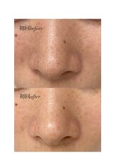 リコア(Likoa)/初回のbefore afterです