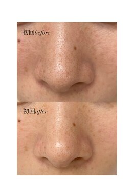 リコア(Likoa)/初回のbefore afterです