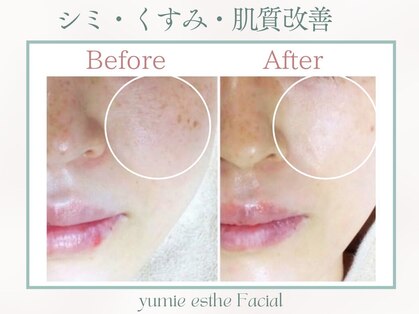 トータルビューティー ゆみえエステ(Total Beauty)の写真