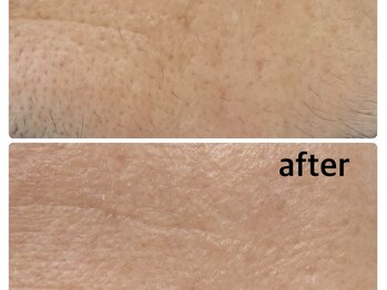 メイクマジック(Makemagic)/額のうぶ毛、古い角質除去