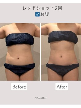 なごみ/痩身◆脂肪分解レッドショット