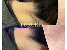 ツルリの雰囲気(自己処理が難しいうなじも、すっきり美しい仕上がりへ♪)