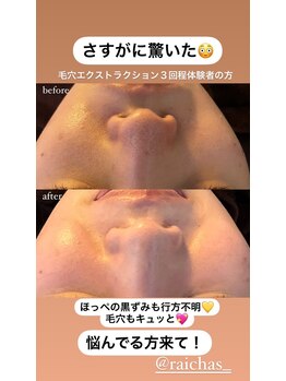 ライチャス(RAICHAS)/ハイドロフェイシャル