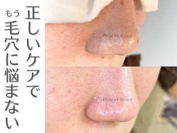 ベルエドゥース(Belle et Douce)/正しいケアでもう毛穴に悩まない