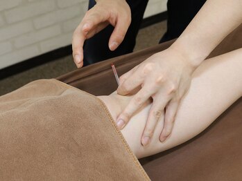 はぴねす鍼灸整骨院 千里丘院/鍼灸