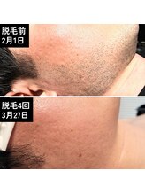 ラフ(LaFF)/ヒゲ脱毛Before＆After