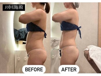 痩身革命 大宮店/ 施術写真(痩身)