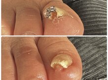 さあちゃん式フットケア アンド 巻き爪 ハンドケア アンド 深爪専門店の雰囲気（どこでも改善されなかった巻き爪もお任せ下さい☆）