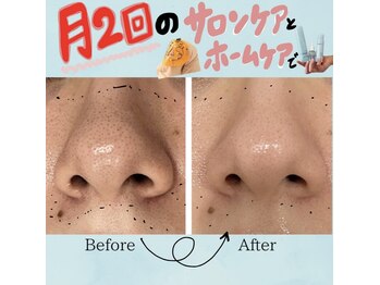 リヴェーヌ 呉羽店(Riverne)/毛穴も一度でキュッ☆