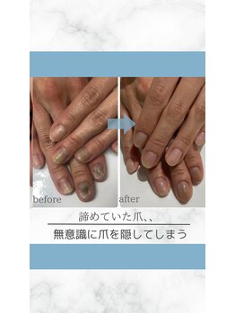 ティアラネイル 宇都宮/深爪矯正