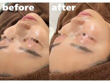 ホワイトラボ 堺東(White labo)/【30代女性 施術3回目の効果】