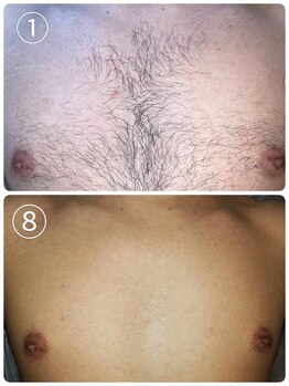 ミスターアンドミス脱毛専門店 難波店(Mr.&Ms.脱毛専門店)/脱毛での清潔感！