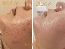 グラン ジュテの雰囲気（ララピール越えプラピールやエクソソームで爆速艶肌美肌に。）
