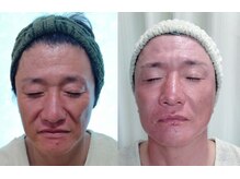 ソフィーム/エンビロンリフトフェイシャル