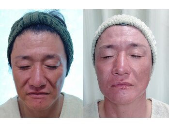 ソフィーム/エンビロンリフトフェイシャル