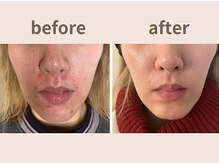 エヴァル 久留米店(ewalu)/ハーブピーリング×ララピール