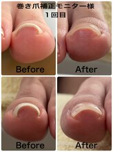 ティアラ(Tiara)/[Foot] 巻き爪補正