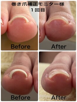 ティアラ(Tiara)/[Foot] 巻き爪補正