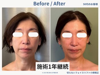 グロウズ(Glows)/何歳からでもたるみ改善が可能◎