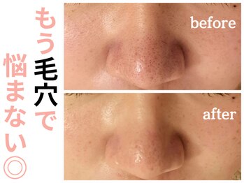 エリン(ERIN)/毛穴徹底洗浄