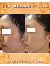 ナイア(naia)/最新型超音波＆小顔マッサージ