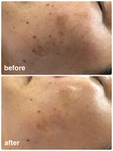 エム 佐賀江北店(EMU)/薄くなっていくシミ！