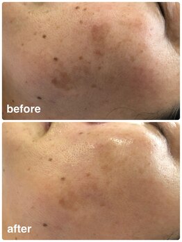 エム 佐賀江北店(EMU)/薄くなっていくシミ！