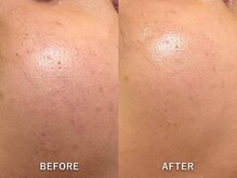 エリンダ(E LINDA)/毛穴洗浄