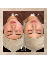 ウリ(uli beauty)/比較写真