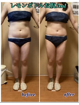 カラーリリー(calla lily)/レモンボトルボディ