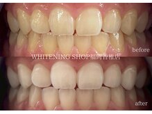 ホワイトニングショップ 福岡香椎店/美容ホワイトニングbefore after