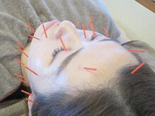 あいここ/ツボや筋肉に刺鍼