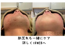 ロココ 中津店(Lococo)の雰囲気（丁寧な施術が高評★園児から70代まで。男性もご相談ください）