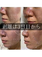 ディオーネ 麻布十番(Dione)/【ハーブピーリング】