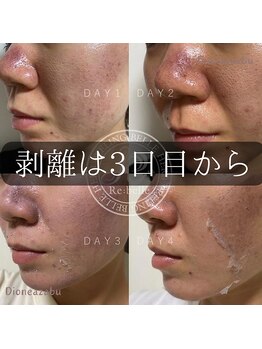 ディオーネ 麻布十番(Dione)/【ハーブピーリング】