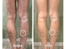 アトリエール(Ateliere)/辛かった静脈の滞りがラクに！！