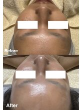 リノ(lino)/コラーゲンアンプル