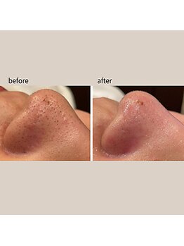 エクリュ(ecru)/毛穴スッキリ