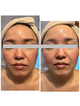 エルブラン(Herb ame)/輪郭/ほうれい線/たるみ改善