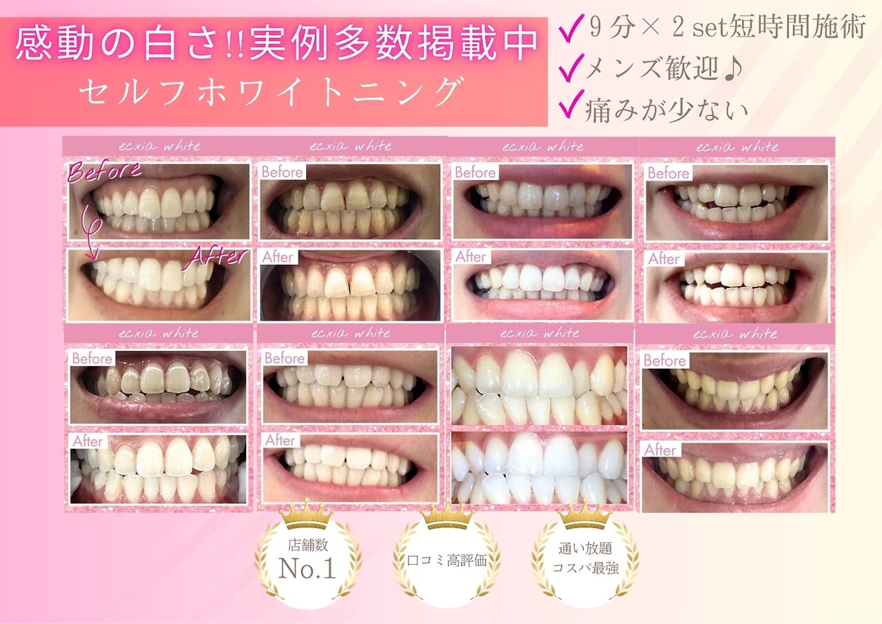 セルフホワイトニング本体 値下げしました！ 付属品あり！サロンの副収入などに エクシアホワイトニング 和歌山本町店｜ホットペッパービューティー