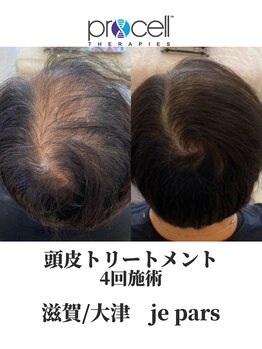 ジュパール(je pars)/プロセル頭皮トリートメント
