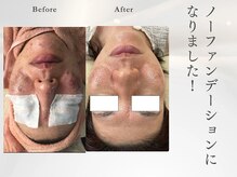 サロン ルテラ(SalonRutella)/肌質改善