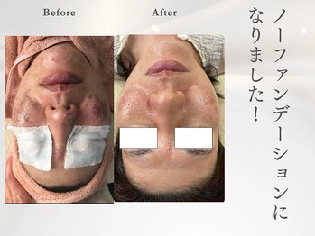 サロン ルテラ(SalonRutella)/肌質改善