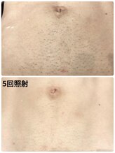 ビューティーアンドボディメイクBB シャオ西尾店/メンズ脱毛☆