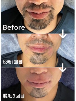 トータルメンズエステ キング(KING)/細かいデザイン脱毛もお任せ♪