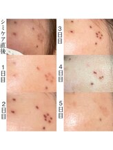 ファミリーセルフサロン 輪(Wa)/シミケア外れ方