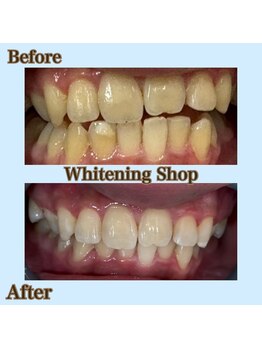 ホワイトニングショップ 津田沼店/before&after美白ホワイトニング