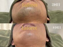 ラフォーレ 岸和田店/ヒゲ脱毛